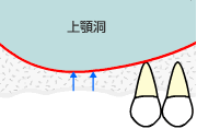 大阪　インプラント　ソケットリフト　歯槽骨の吸収